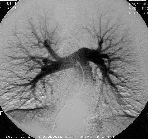 Pulmonalisangiography