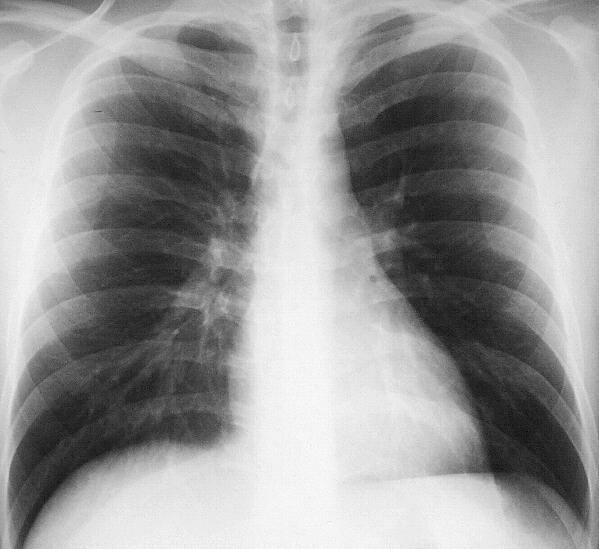 Röntgenbild flecken lunge weiße Sind weiße